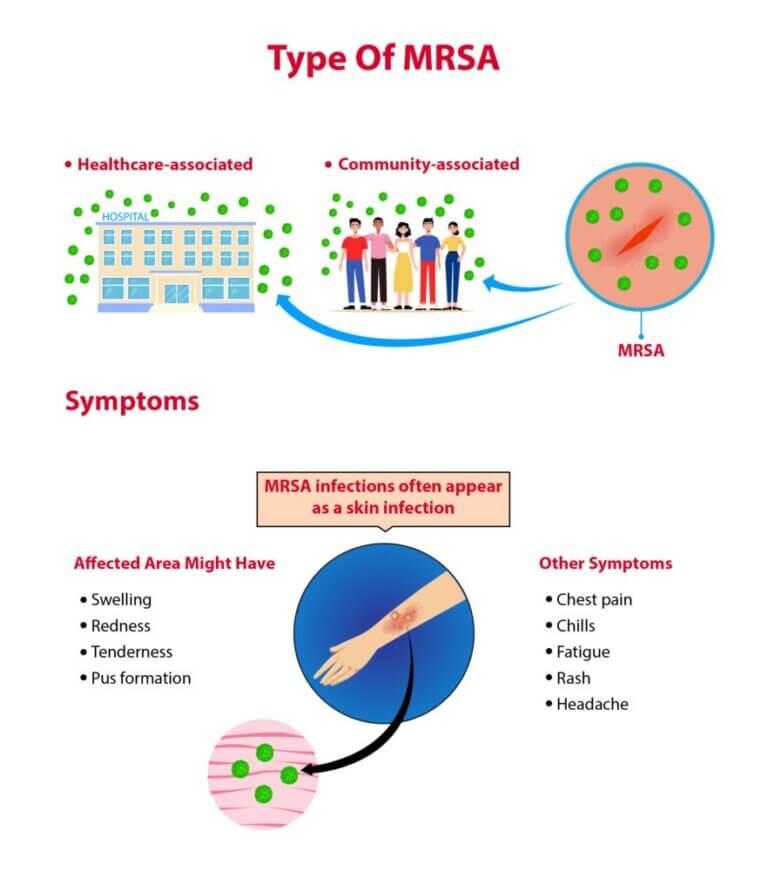 Mrsa Facts Symptoms And Prevention Tips