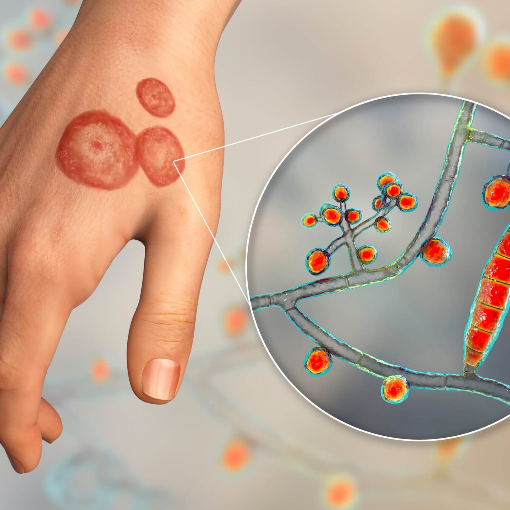 Trichophyton mentagrophytes: The Threat and its Management