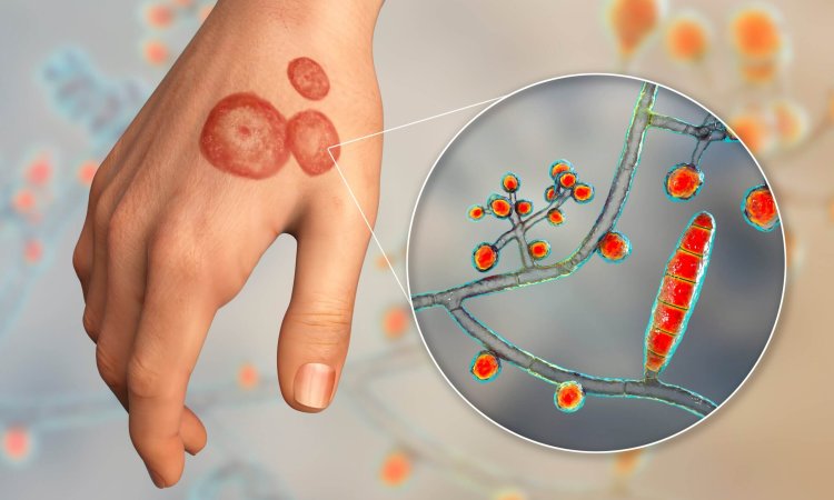 Trichophyton mentagrophytes in Cosmetics