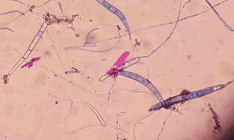 Trichophyton mentagrophytes and Antifungal Treatments