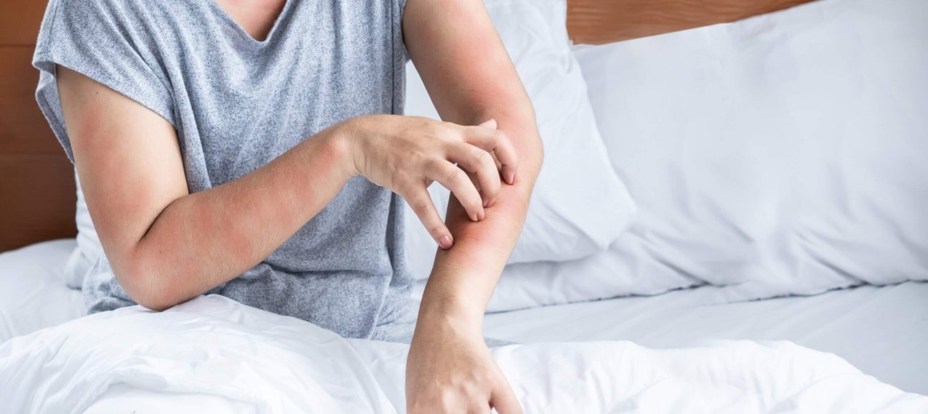 Impact of Bed Bug Infestations on Quality of Life